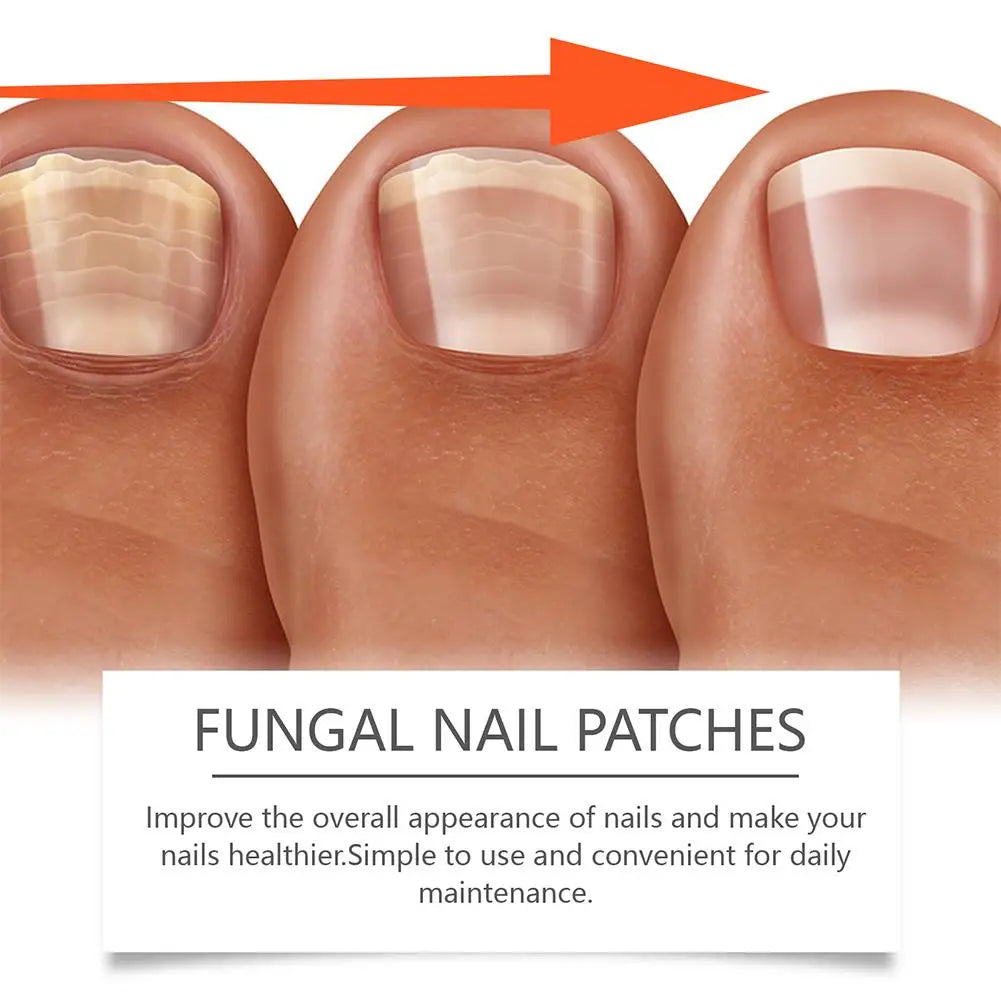 Fungal Nail Repair Patches – Anti-Infection Nail Treatment (1–3 PCS)